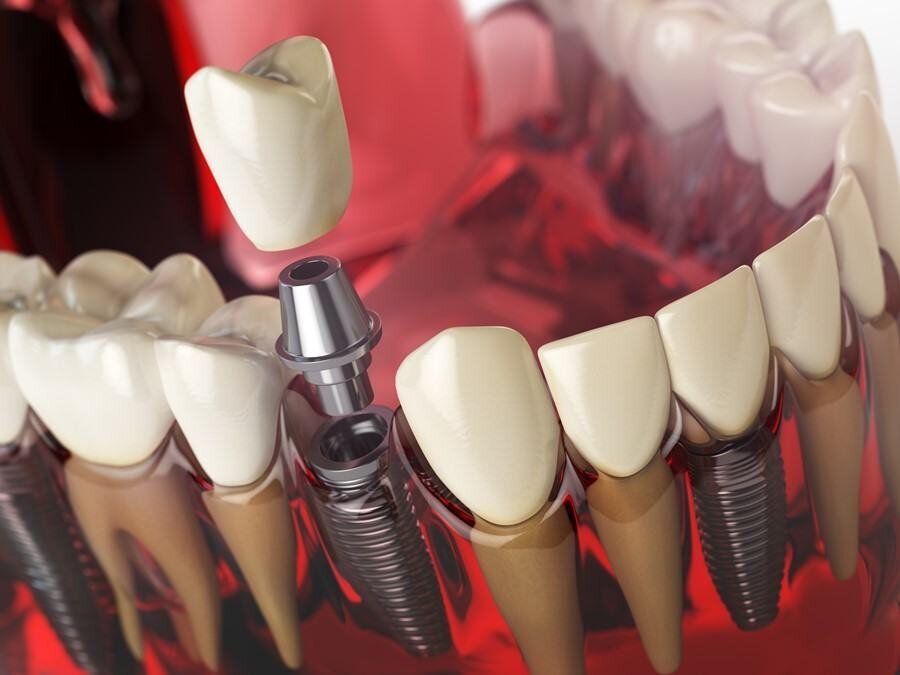Estructuras y componentes para implantes